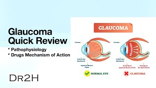 Glaucoma Quick Review  Explain Clearly [upl. by Yanahs]