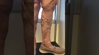 Varicose Veins Cosmetic or Medical [upl. by Nylirej238]