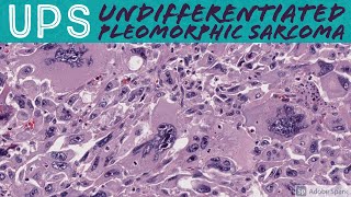 Undifferentiated Pleomorphic Sarcoma 101 UPS formerly malignant fibrous histiocytomaMFH [upl. by Oirazan]