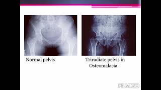 MCQs on OBG Contracted pelvis  helps in viva and AIAPGET exams [upl. by Bozovich113]