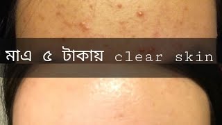 Fungal acne treatment in home with only 5 tk [upl. by Kirre]