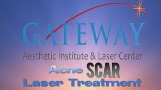 Acne Scar Laser Treatment  Gateway Aesthetics [upl. by Arraek321]