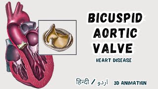 Bicuspid Aortic Valve Kon Si Disease Hai  3D animation in हिंदी  اردو  cardiology [upl. by Kwan]