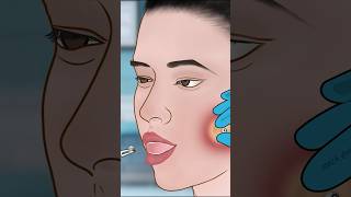 ASMR Dimple piercing infection treatment P1asmr animation satisfying trending shorts [upl. by Hadeehsar]