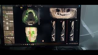 CBCT 3D Digital scan 13 × 16 [upl. by Rosalie]