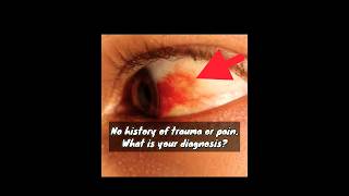 Subconjunctival Hemorrhage mbbs neetpg [upl. by Cris]