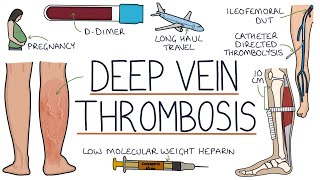 Understanding Deep Vein Thrombosis DVT [upl. by Ylekalb557]