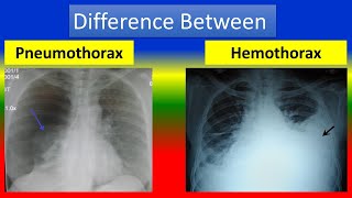 Difference between Pneumothorax and Hemothorax [upl. by Remoh]