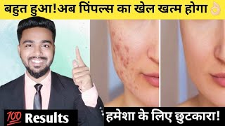 Pimple removal on face at homePimples removalPimple ke daag kaise hatayePimples hatane ka tarika [upl. by Nemad]