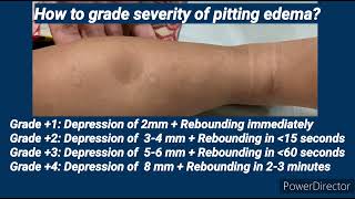 Pitting Edema I Pediatrics [upl. by Caleb]