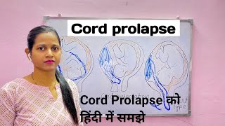 Cord prolapse causes types management lecture in Hindi all nursing exams [upl. by Tjon125]