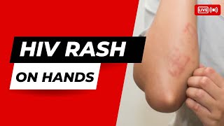 HIV Rash on Hands [upl. by Nan]