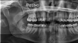 48 Coronectomy [upl. by Dorcus]