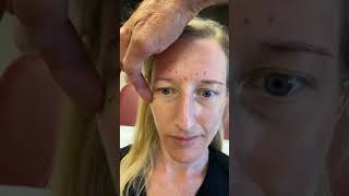 Xeomin Brow Lift on 31 Year Old Woman [upl. by Ylra]