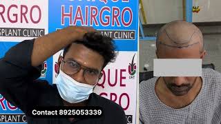 7 month Hair Transplant Before amp after  Unique Hairgro hair transplant Clinic [upl. by Oriole795]