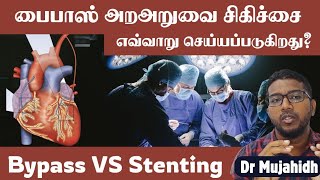 Stenting vs Bypass surgery in tamil  Bypass surgery எவ்வாறு செய்யப்படுகிறது Dr Mujahidh [upl. by Hsital]