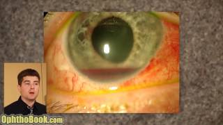 Exploding Eye Lecture [upl. by Htebzil]