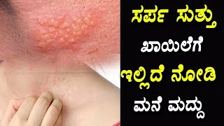 ಸರ್ಪ ಸುತ್ತು ಖಾಯಿಲೆಗೆ ಇಲ್ಲಿದೆ ನೋಡಿ ಮನೆ ಮದ್ದು   Kannada Health Videos [upl. by Anisah]