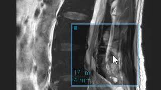 Low marrow signal in a patient with multiple blood transfusions [upl. by Fleta]