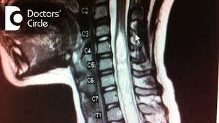 How to manage Syringomyelia in 45 year old  Dr Mohan M R [upl. by Brigitta241]