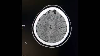 VasculitisFibromuscular dysplasia [upl. by Gunas740]