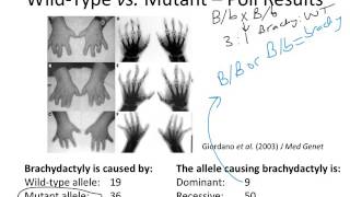 brachydactyly [upl. by Nerb]