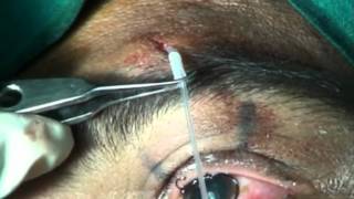 PTOSIS SURGERY VIA SUPRABROW SINGLE STAB INCISIONnew technique frontalis sling Soosan Jacobmpg [upl. by Nauqas]