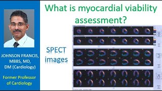 What is myocardial viability assessment [upl. by Sseb]