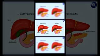 Dyslipidemia type 4  Familial hypertriglyceridemia [upl. by Milon601]