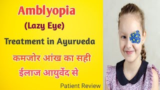 Amblyopia  Ayurvedic Eye Treatment [upl. by Alisun916]