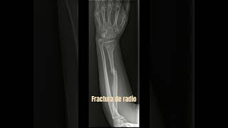 fracturas fracturabrazo fracturaradio medicina radiologia radiologo radiografia [upl. by Nairred970]