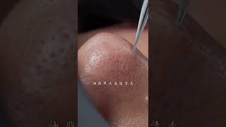 Take good care of your skin during the season change immersiveskincare blackheads asmr facespa [upl. by Vachel]