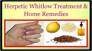 Herpetic Whitlow Treatment amp Home Remedies [upl. by Arhna]