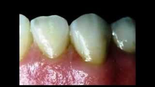 PRÓTESE DENTÁRIA PROTÉTICO IMPLANTES PORCELANA PONTEMÓVEL COROAS FACETAS ATTACHMENTS [upl. by Zebapda529]