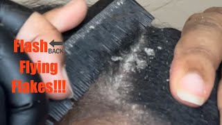 Dandruff Scratching Psoriasis Scalp Lots of Stubborn Crunchy Flakes Popping [upl. by Benjamin]