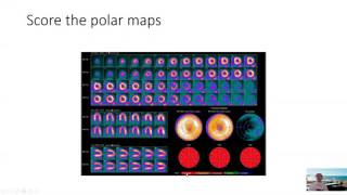 Reading a Normal Cardiac PET Scan [upl. by Percy]