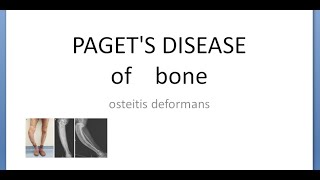 Orthopedics 336 Pagets disease of bone osteitis deformans Absent Haversian CALCITONIN [upl. by Ammon]