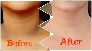 How To Get Rid of Dark Neck in 15 Minutes  Fast and Quickly [upl. by Alage]