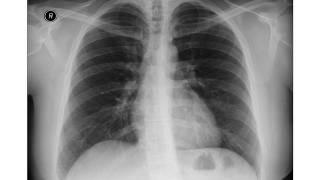 Chest xray Eventration of Diaphragm [upl. by Ermanno]