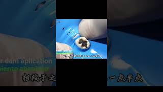 Removing retraction cord after tooth RCT amp composite restoration shorts [upl. by Phillip402]