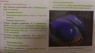 Keratoconjunctivitis Sicca  EYE [upl. by Arleyne]