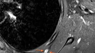 Elastofibroma Dorsi or hemangioma [upl. by Aig]