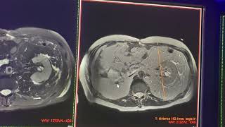 Mielolipoma vs lipoma perirrenal gigante vs liposarcoma retroperitoneal [upl. by Shauna]