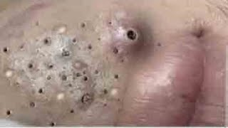 Big Cystic Acne Blackheads Extraction Blackheads amp Milia Whiteheads Removal Pimple Popping  3752 [upl. by Yesdnyl]