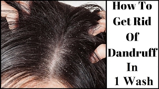 quotHow to Remove Dandruffquot Just in 1 Wash  Home Remedies for Dandruff [upl. by Rollo316]