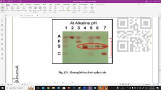 Hemoglobin Electrophoresis amp G6PD test  Medical Biochemistrry [upl. by Ahmar]