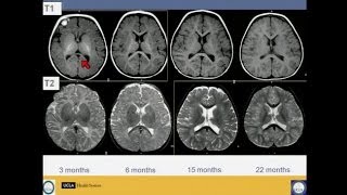 Neuroimaging of Pediatric Disease [upl. by Koralie]