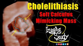 Cholelithiasis  Soft Calculus Mimicking Mass  Ultrasound  Case 317 [upl. by Cibis]