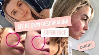 My RF Skin Resurfacing Experience [upl. by Aleuqahs]