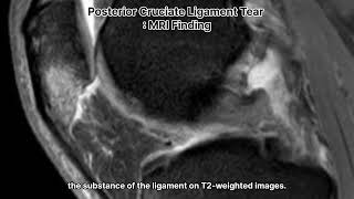 Posterior Cruciate Ligament PCL tear  MR Finding [upl. by Mcwherter]